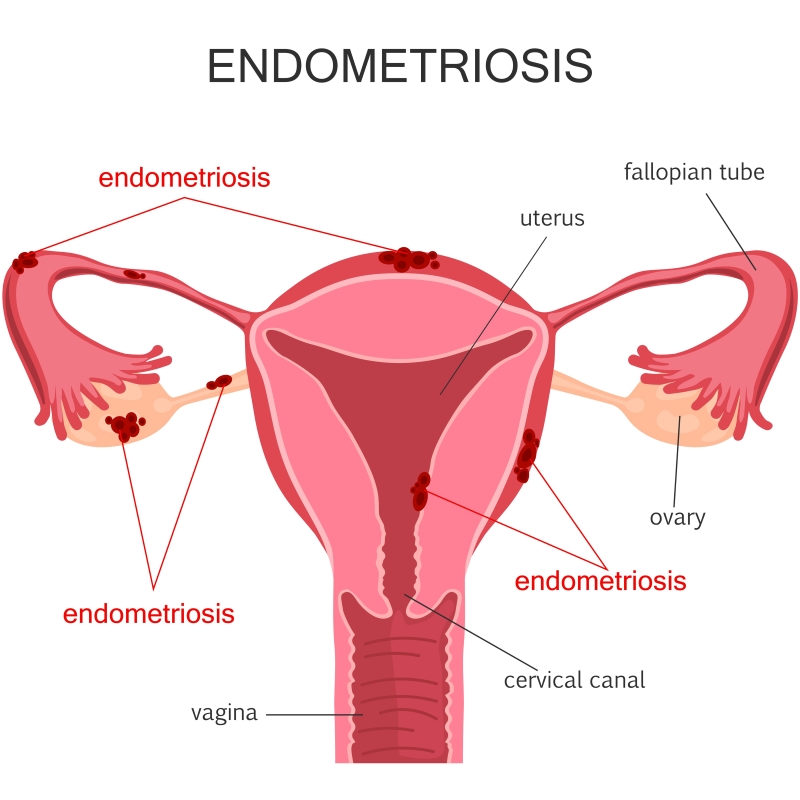 Endometriosis diagram_163459147
