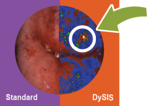 Pap Smear Abnormal Result