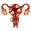 Uterine fibroids can cause discomfort and impact a woman's fertility.