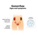 gonnorhea diagram_101739090
