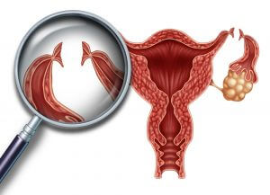 Tubal ligation is a permanent form of female sterilization.