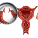 Tubal Ligation: When Should I Get my Tubes Tied?