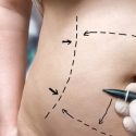 What is the Purpose of Liposuction?