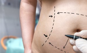 Liposuction concept