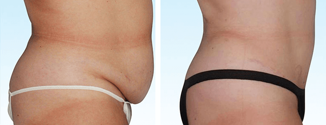 Abdominoplasty-Tummy-Tuck-Before-and-After-Photo