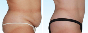 Before and After Photo of Tummy Tuck Procedure