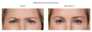 Botox Cosmetic patient results