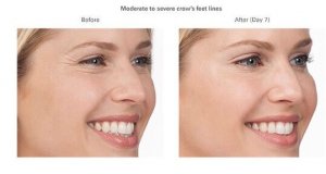 Botox Cosmetic for Crow's Feet