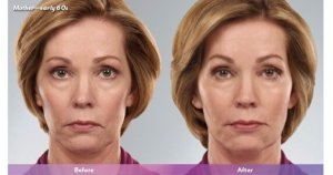 Juvederm Plus before and after
