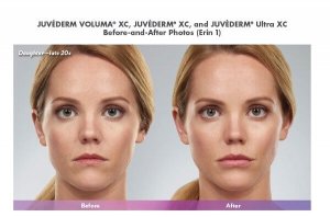 Juvederm Voluma, Juvederm Ultra patient