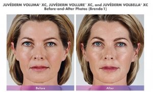 Juvederm Voluma, Vollure and Volbella patient before and after
