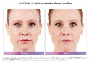 Juvederm - Cosmetic Fillers before and after photos