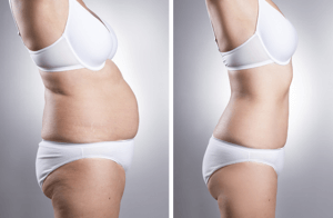 Liposuction-Before-and-After-Photo