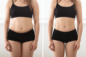 Medical-Weight-Loss-Before-and-After-Photo