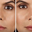 How Long Do Fillers Last, and Who’s a Good Candidate?