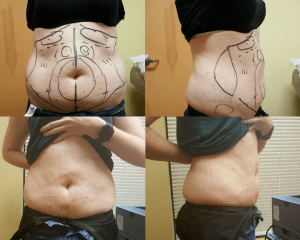 360 Liposuction: A Patient's Guide to Getting 360 Lipo in Atlanta