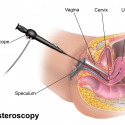 Hysteroscopy