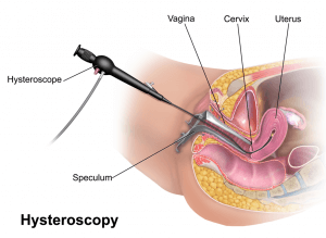 Hysteroscopy diagram
