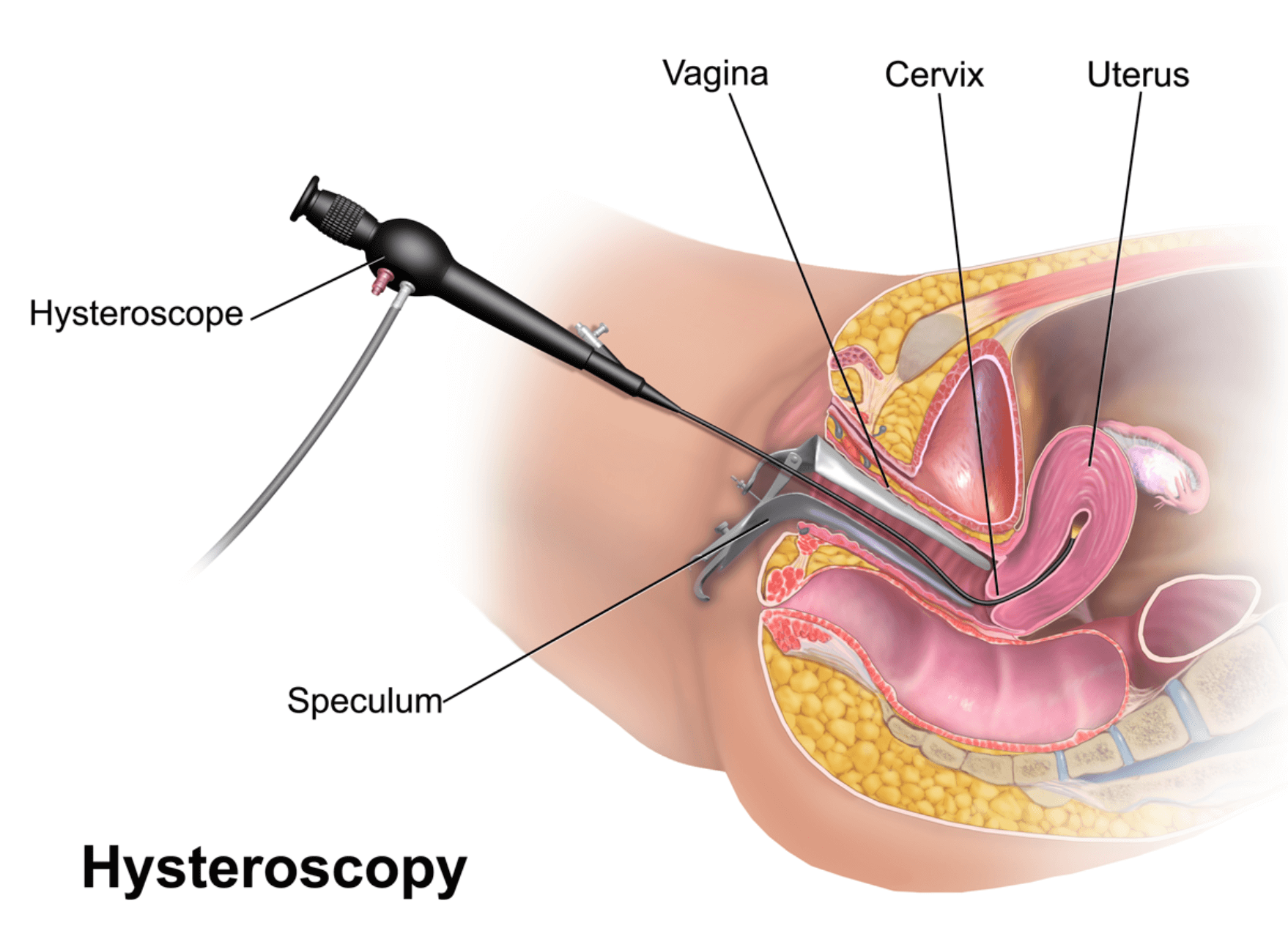 Hysteroscopy diagram