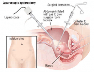 lap hysterectomy diagram
