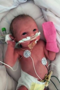 Preemie baby Aurelia Before Pic