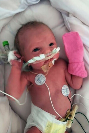 Preemie baby Aurelia Before Pic