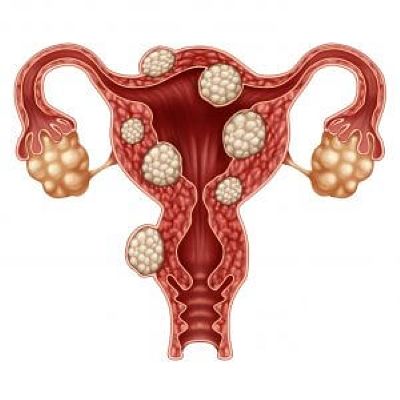 uterine fibroids