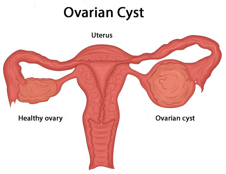 What Causes Ovarian Cysts and How are They Treated?
