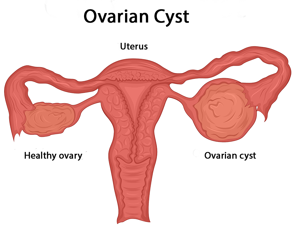 Ovarian cysts diagram AdobeStock 169410300 3 Cherokee Women s Health