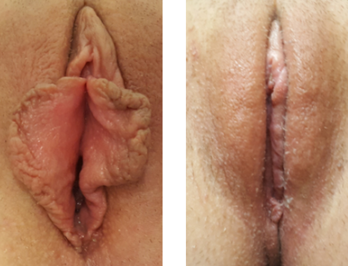 20 YR OLD LABIAPLASTY