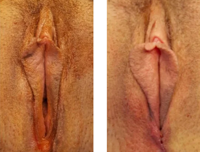 45 YR OLD PERINEOPLASTY SAME DAY POST OP