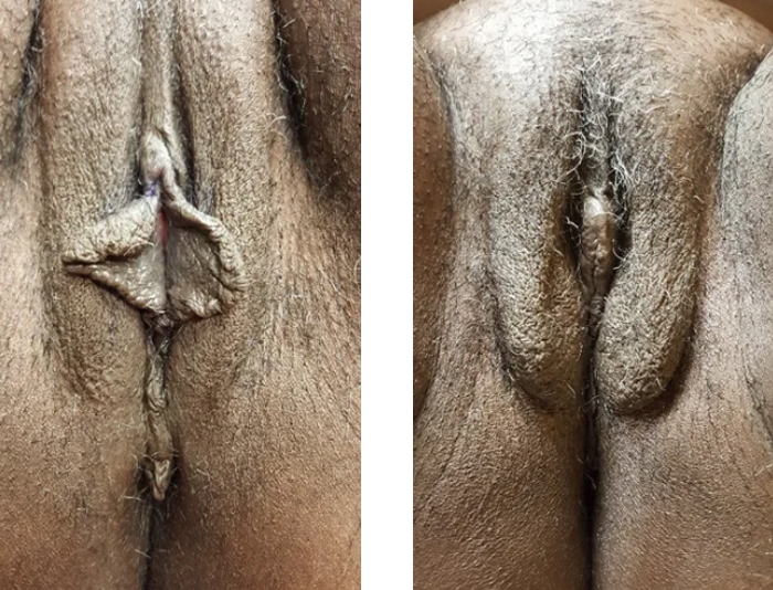 50 YRS OLD LABIAPLASTY 