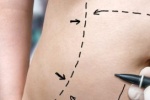 liposuction belly markings