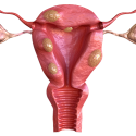 Uterine Fibroids: What You Should Know