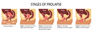 Stages-of-Prolapse-Diagram_363781143-1