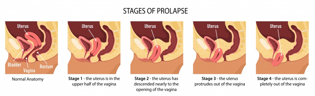 Causes of uterine prolapse