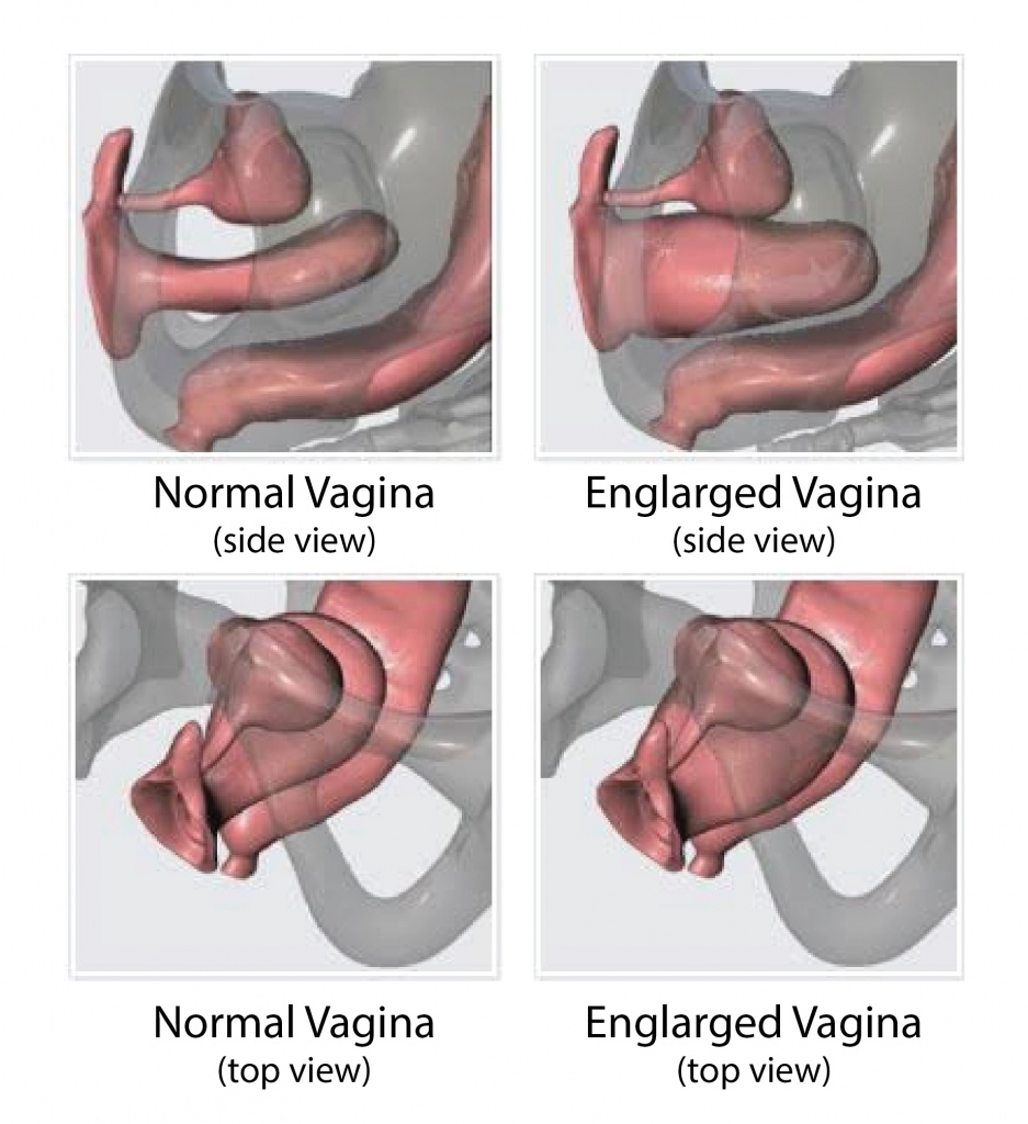 Vaginal Rejuvenation and Other Female Genital Cosmetic Surgery