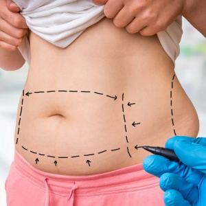 tummy tuck photo