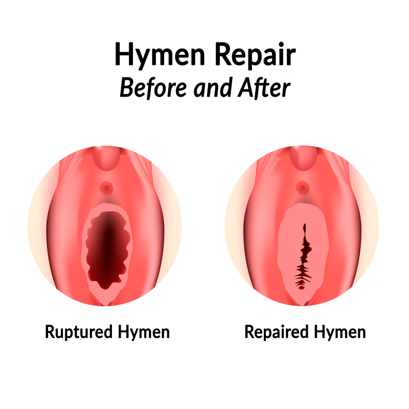 hymen reconstruction