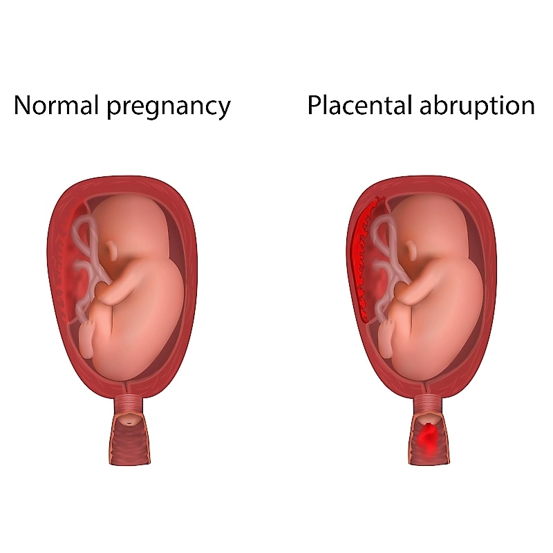 placental abruption_324535153