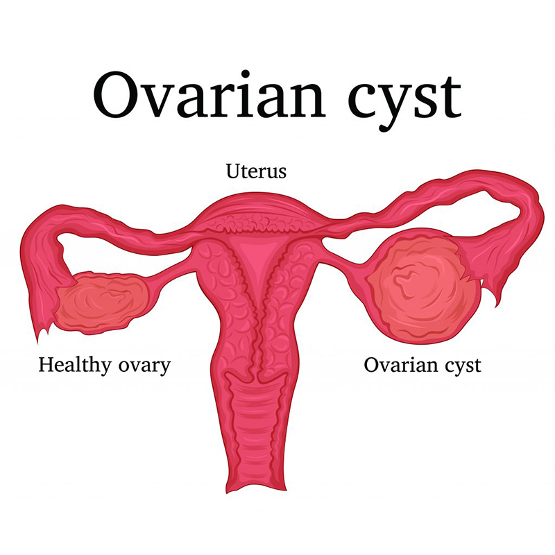 Ovarian cyst discount bleeding between periods