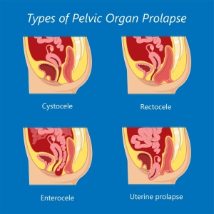 types of prolapse