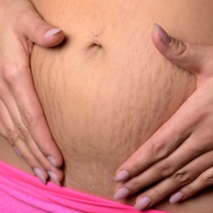 pregnancy stretch marks_91558027