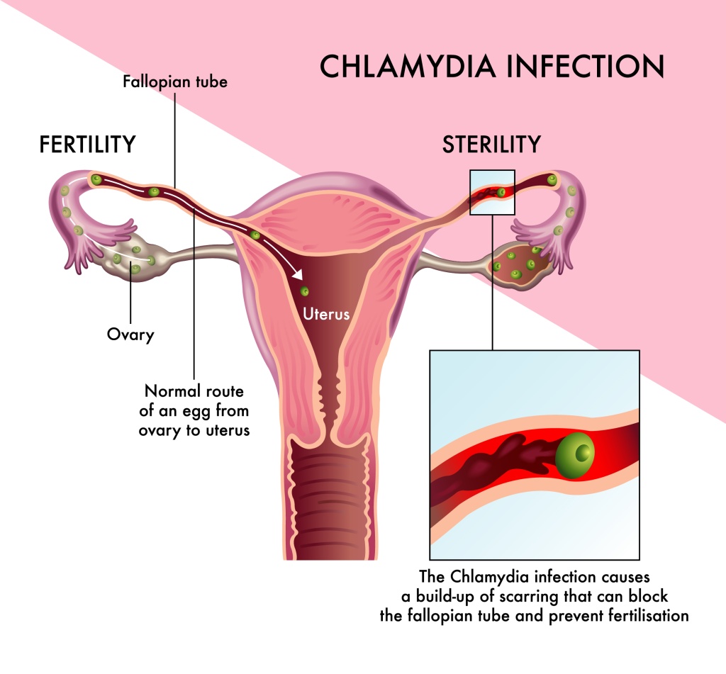 Can Chlamydia Cause Infertility Cherokee Women s Health