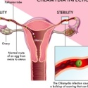 Chlamydia-Diagram_188449915-01