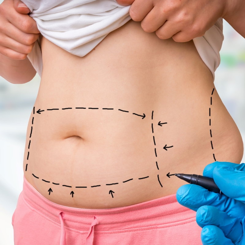 Skin After Weight Loss. How to Keep Elasticity? - Atlanta