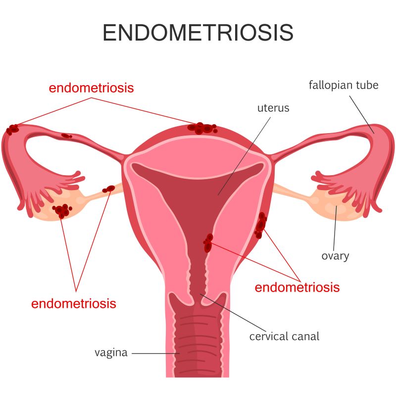 endometriosis-graphic_163459147
