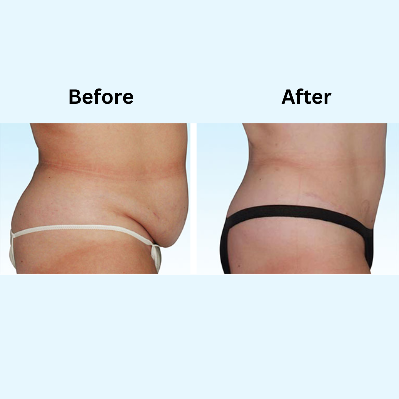 The benefits of TUMMY TUCK may be more than just a trim tummy