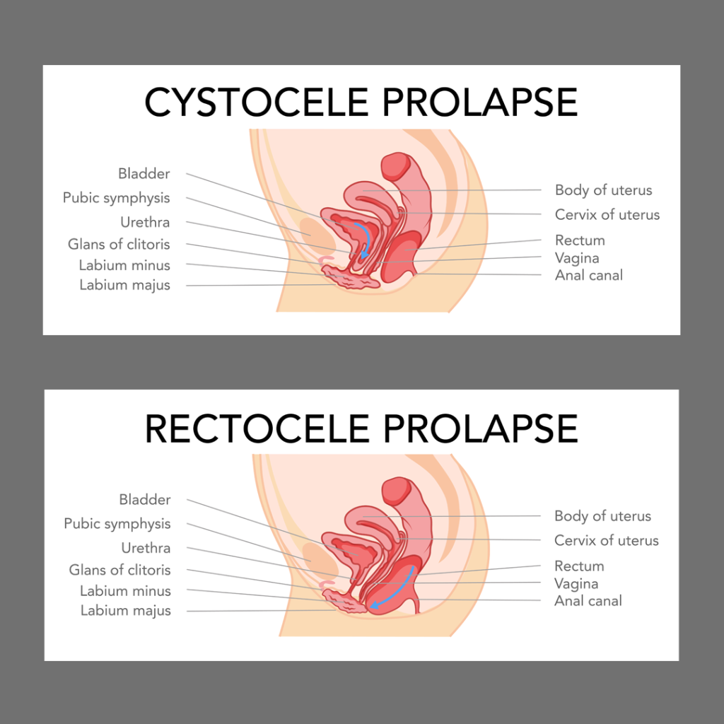cystocele and rectocele prolapse diagrams