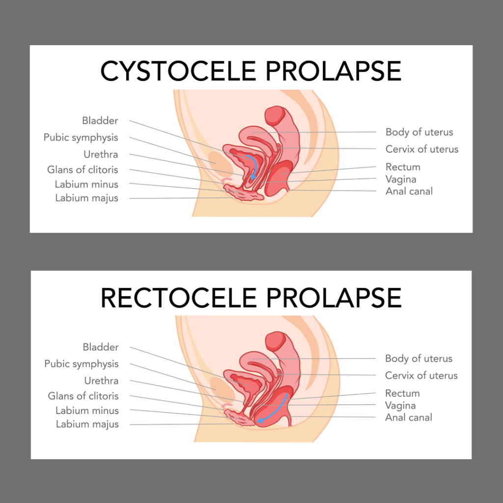 Vaginal Hysterectomy for Uterine Prolapse and Vaginal Repair